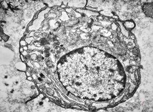 M,64y. | bone marrow - plasmocytoma